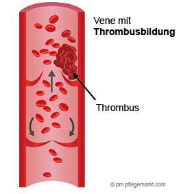 Darstellung eines Thrombus an der Venenklappe